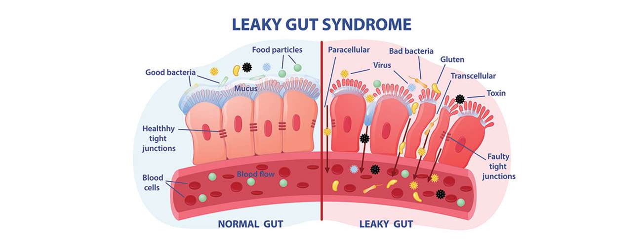 Verschil tussen lekkende darm syndroom en normale darm